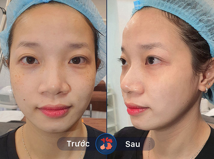 Ms.Lan - Không chỉ vết nám mà tàn nhang cũng dần biến mất, giúp chị Lan có làn da đẹp hơn