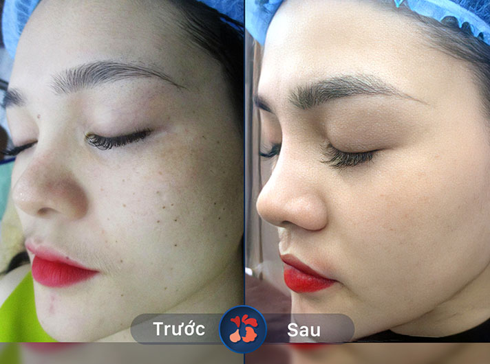 Ms.Hồng - Kết quả điều trị nám của chị Hồng rất tuyệt vời. Làn da trở nên sáng mịn và không còn vết nám nào nữa