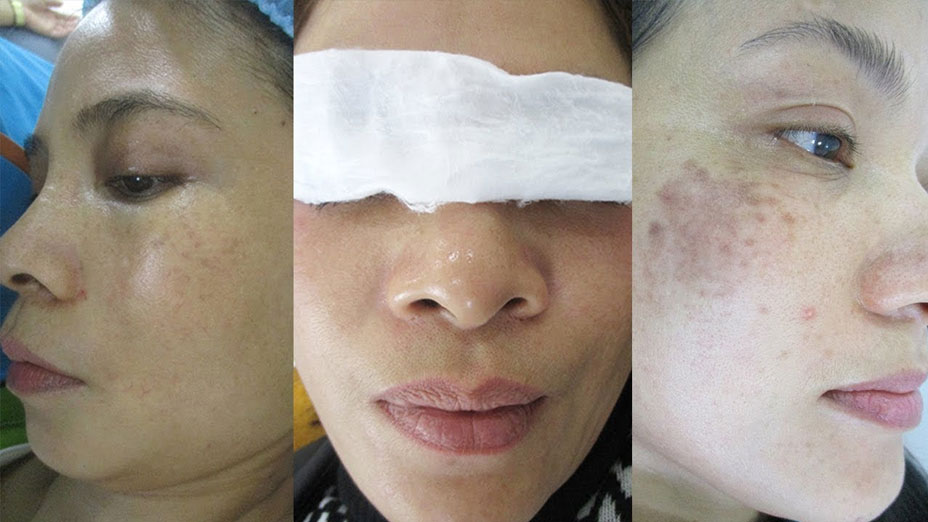 Tổng hợp khách hàng trị Nám thành công tại BVTM Kangnam