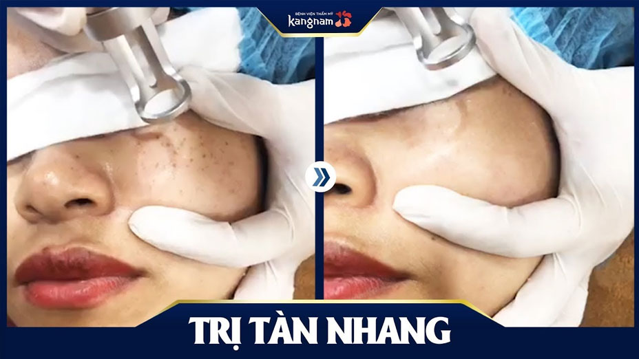Cận cảnh trị tàn nhang bằng Laser Picosure