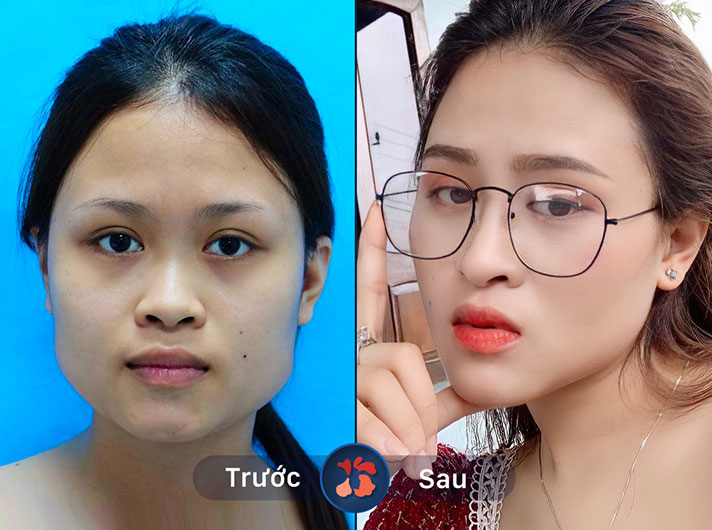 Ms.Lê Minh Anh - Đường nét khuôn mặt trở nên rõ ràng và hấp dẫn hơn