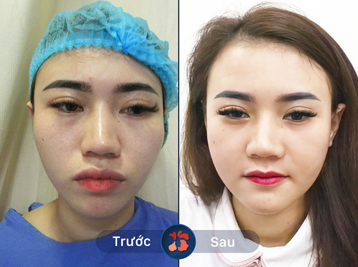 Ms.Nguyễn Thu Hà - Sau khi làm hàm mặt, khách hàng cảm thấy khuôn mặt mình trẻ trung hơn