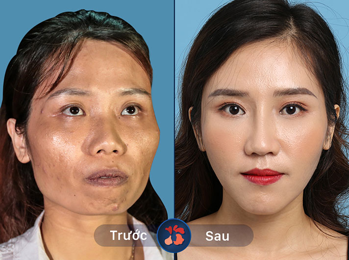 Ms.Phạm Ánh Tuyết - Khuôn mặt đã thay đổi hoàn toàn, trở nên hài hòa và cuốn hút