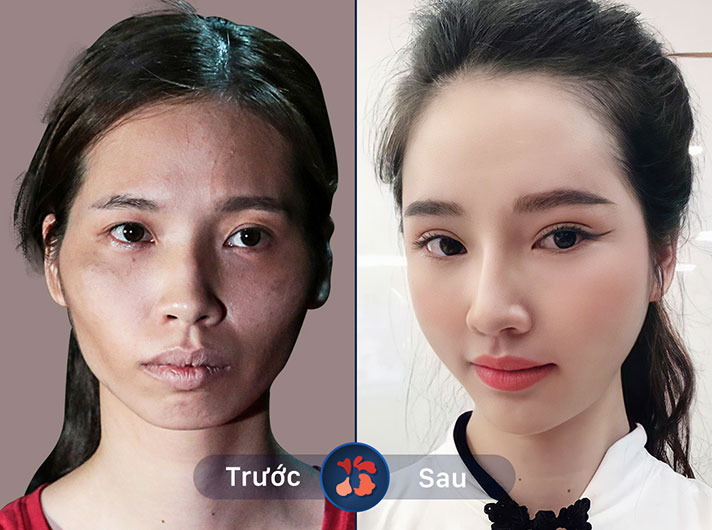 Ms.Trần Thu Phượng - Thẩm mỹ mặt giúp chị Phượng cảm thấy tự tin hơn khi giao tiếp với mọi người