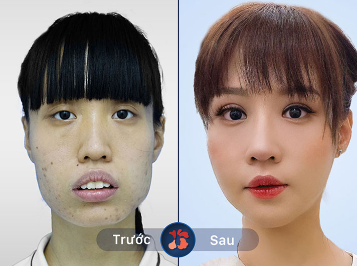 Ms.Nguyễn Ngọc Lệ - Đã có được khuôn mặt mơ ước sau khi thẩm mỹ hàm mặt