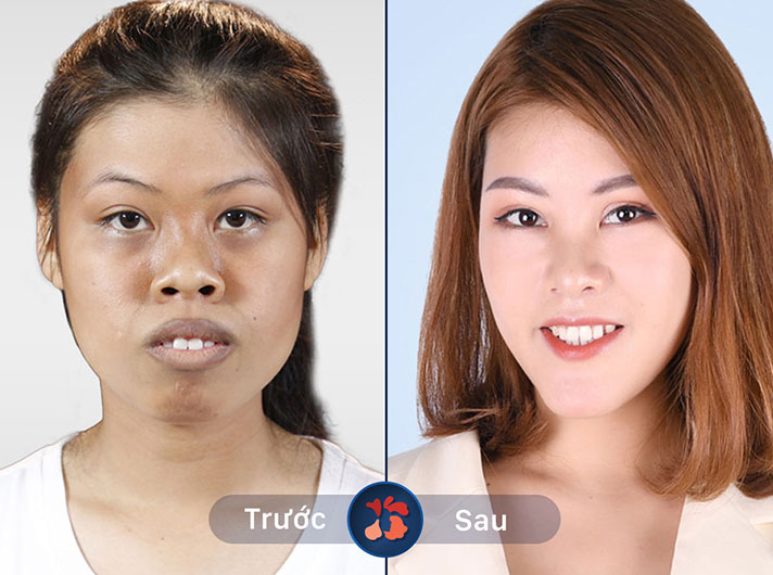 Ms.Nguyễn Minh Thu - Chị Thu rất hài lòng với kết quả sau khi thẩm mỹ hàm mặt