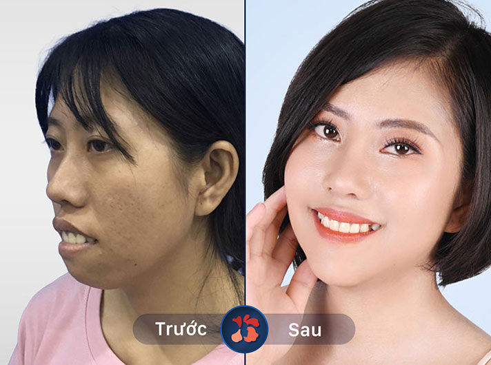 Ms.Phạm Ánh Kim - Khuôn mặt khách hàng trở nên thanh tú và cân đối hơn nhiều