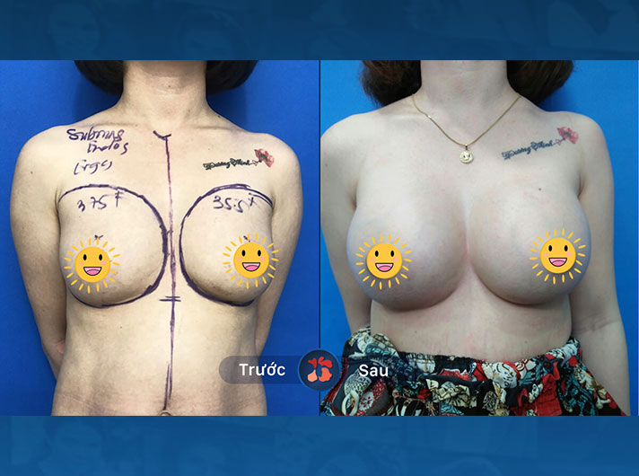 Ms.Linh - Đã trải qua nhiều nỗi lo lắng về tình trạng ngực lệch của mình, nhưng giờ đây nhờ dịch vụ nâng ngực này, chị Linh đã có thể tự tin hơn