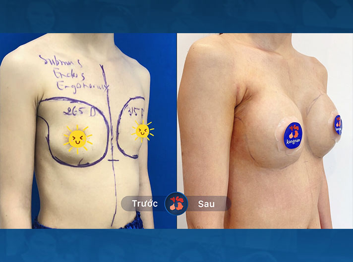 Ms.Lan - Vòng một của chị Lan trở nên đầy đặn hơn nhưng vẫn rất tự nhiên và hài hòa với cơ thể