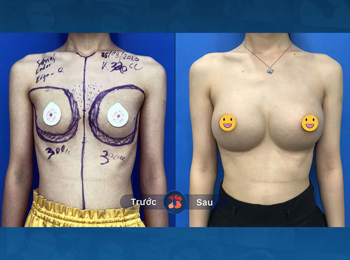 Ms.Bình - Ngực có kích thước và hình dáng rất cân đối, tự nhiên như những gì chị Bình mong muốn.