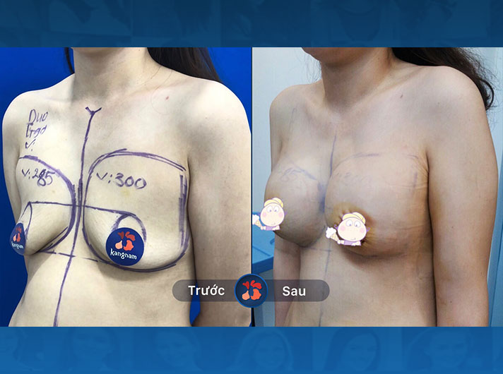 Ms.Đức - Chị Đức rất yêu vẻ ngoài tự nhiên của bầu ngực sau khi nâng, các bạn sẽ khó có thể đoán ra tôi đã trải qua phẫu thuật