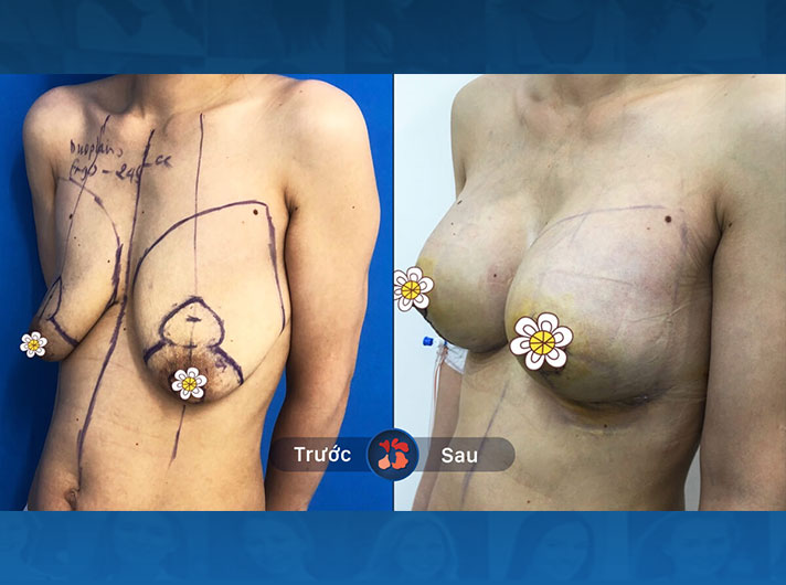 Ms.Dung - Ngực của chị Dung trông rất tự nhiên, săn chắc và đã hết bị chảy xệ