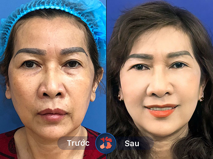 Ms.Mai Linh - Da căng mịn hơn hẳn sau liệu trình căng da