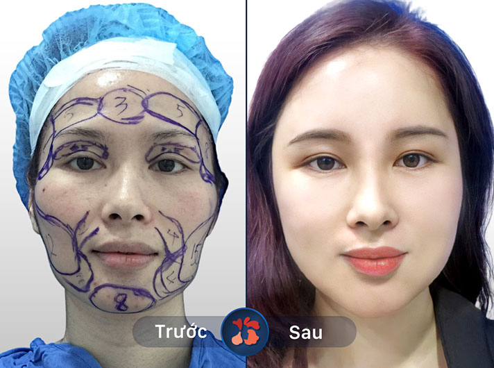 Ms.Ngọc Anh - Kết quả tuyệt vời, da căng mịn và sáng hơn nhiều