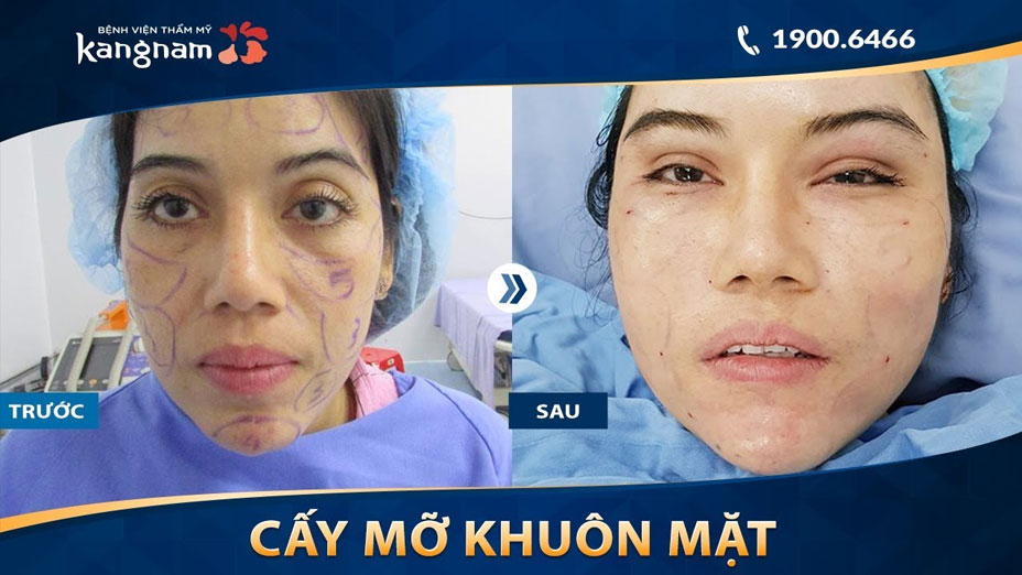 Khách hàng cấy mỡ toàn bộ khuôn mặt tại BVTM Kangnam