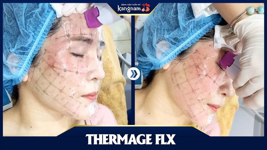 Thermage FLX - Siêu trẻ hóa nâng cơ không phẫu thuật