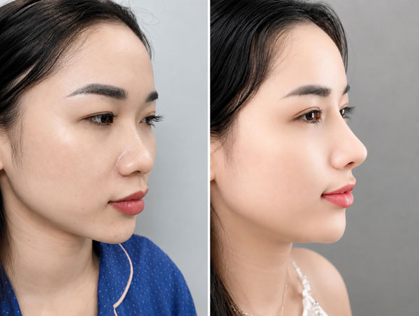 Khách hàng nâng mũi tại Kangnam Bình Dương: dáng mũi sau khi thực hiện cao và tự nhiên hơn so với trước