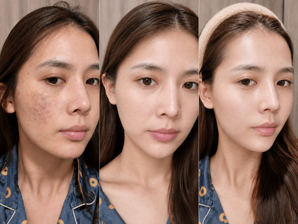 Khách hàng điều trị nám tại Kangnam Bình Dương: làn da đều màu và sáng hơn qua các buổi điều trị