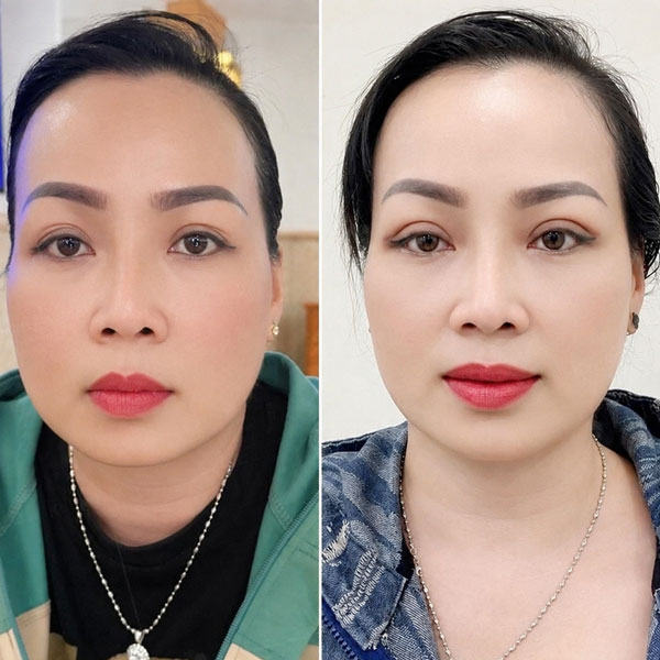 Khách hàng cắt mí tại Kangnam Cần Thơ: mắt sau khi thực hiện có nếp mí hai mí sắc nét, đều và tự nhiên