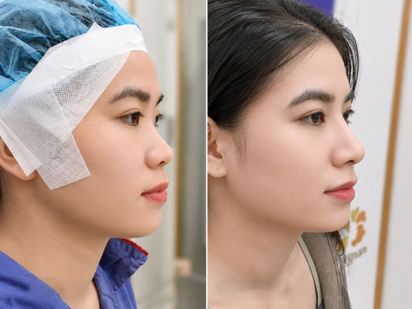Khách hàng nâng mũi tại Kangnam Cần Thơ: dáng mũi sau khi thực hiện mềm mại, thanh thoát và tự nhiên hơn so với trước