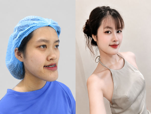 Khách hàng Mai Anh trước và sau chỉnh hình hàm mặt kết hợp cắt mí, nâng mũi tại Kangnam Hà Nội