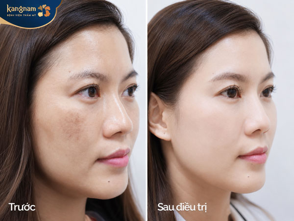 Khách hàng điều trị nám tại Kangnam Hải Phòng: làn da trước có nám, sau điều trị da đều màu và sáng hơn