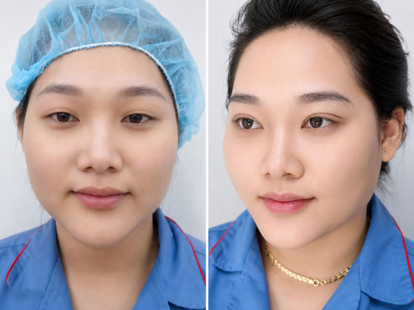 Khách hàng cắt mí tại Kangnam Nghệ An: mắt sau khi thực hiện có nếp mí hai mí rõ và tự nhiên