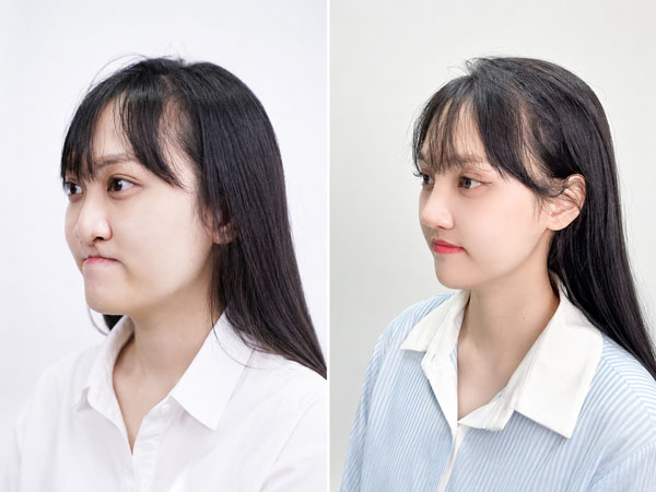 Khách hàng Minh Xuân trước và sau chỉnh hình hàm mặt do sứt môi hở hàm ếch tại Kangnam Sài Gòn