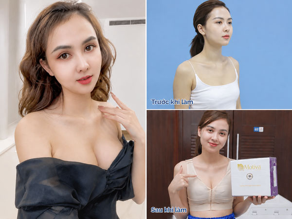 Hot Mom Huyền Giang trước và sau nâng ngực tại Bệnh viện Thẩm mỹ Kangnam Sài Gòn