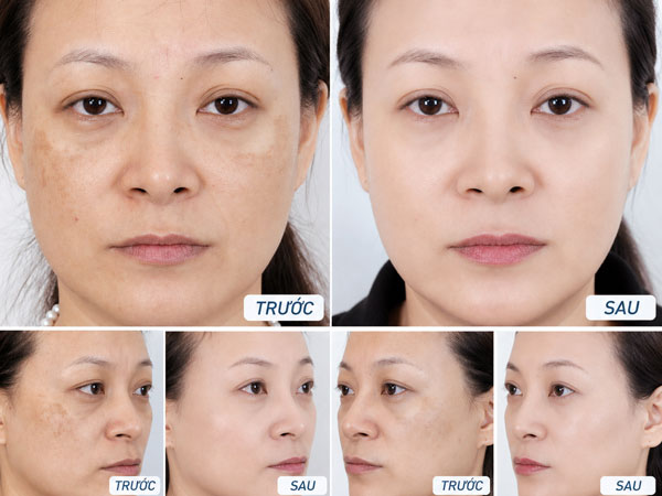 Cải thiện làn da sau liệu trình điều trị nám tại Kangnam Thanh Hóa