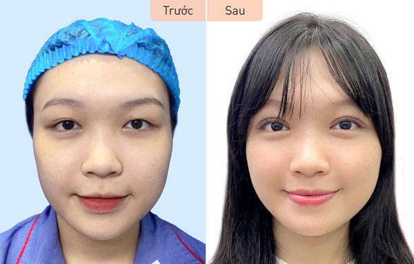 Hình ảnh trước và sau cắt mí và lấy mỡ mí của khách hàng Diệu Quỳnh – Thực hiện tại Kangnam