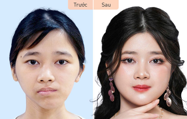 Kết quả Chỉnh hàm lệch trước và sau – Khách hàng Thu Hương tại Kangnam