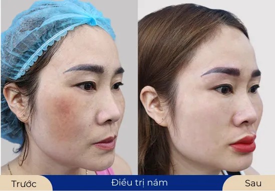 Ms.Minh Châu Lấy lại sự mềm mịn và đầy sức sống sau khi thực hiện điều trị nám