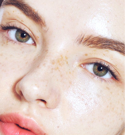 Trị bớt sắc tố