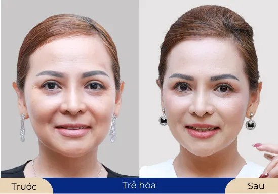 Ms.Hải Yến Làn da trắng sáng sau khi sử dụng dịch vụ trẻ hóa