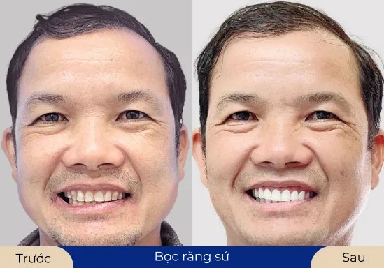 Mr.Quang Thắng Nụ cười tự tin sau khi lựa chọn bọc răng sứ