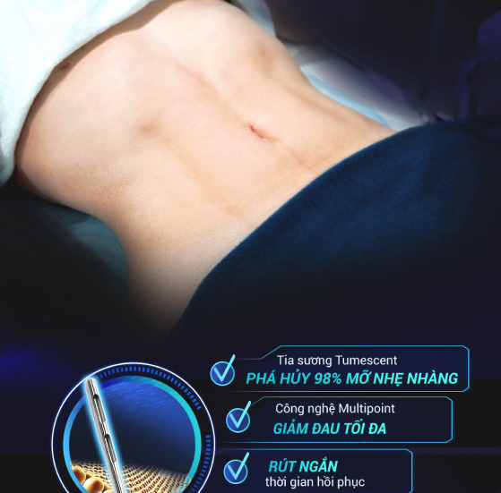 giảm mỡ lipo 360