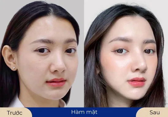 Ms.Yến Hồng Thay đổi thành công với thẩm mỹ hàm mặt