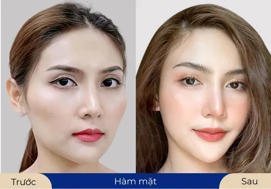 Ms.Ngọc Anh Biển đổi nhan sắc sau khi thực hiện thẩm mỹ hàm mặt