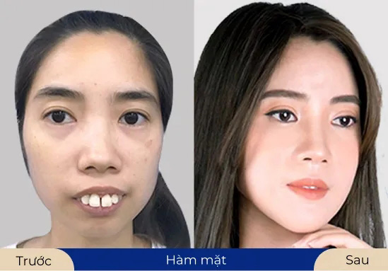 Ms. Hồng Diễm Lấy lại sự tự tin nhờ thẩm mỳ hàm mặt