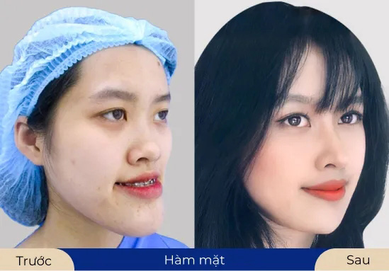 Ms.Mai Duyên Diện mạo mới sau khi sử dụng dịch vụ thẩm mỹ hàm mặt