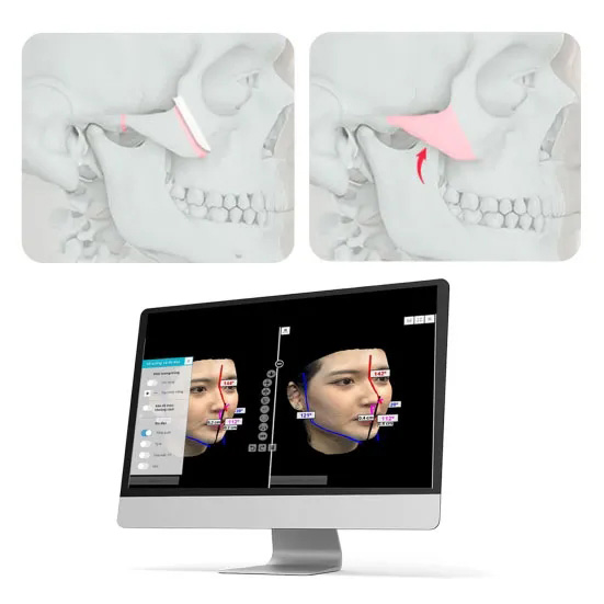 LẬP KẾ HOẠCH PHẪU THUẬT BẰNG MÔ PHỎNG 3D