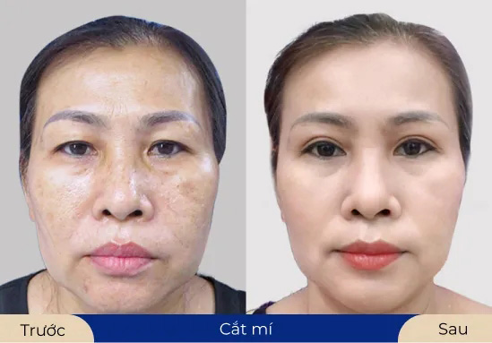 Ms.Ngọc Thảo Sự thay đổi trẻ trung sau khi cắt mí