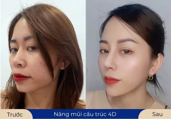 Ms.Yến Trang Chinh phục ánh nhìn sau khi thực hiện Nâng mũi cấu trúc 4D