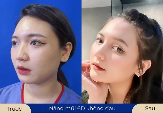 Ms.Quỳnh Giang Lựa chọn dịch vụ Nâng mũi 6D không đau