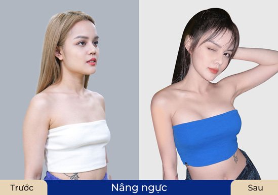 Khách hàng nâng ngực thành công