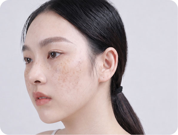 trị bớt sắc tố