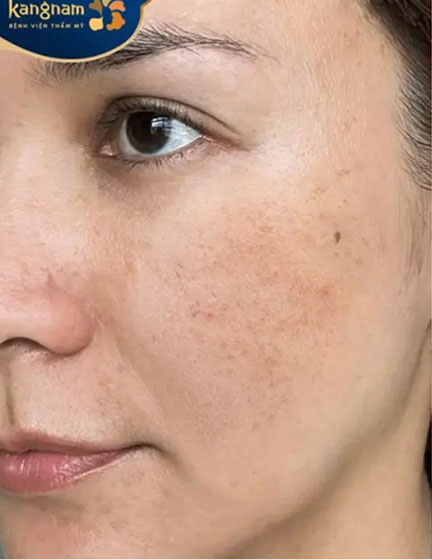 Trước sau cắt cánh mũi 1