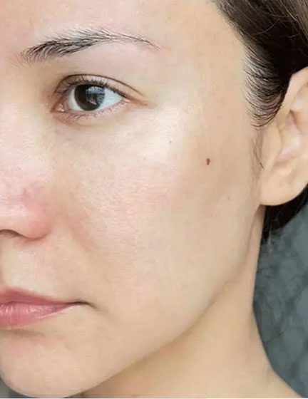 Trước sau cắt cánh mũi 2