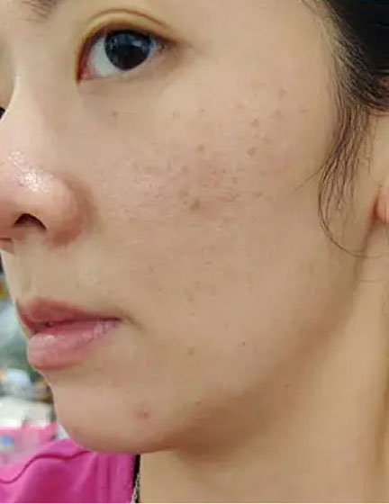 Trước sau cắt cánh mũi 3